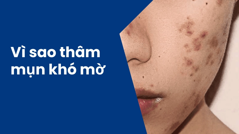  Cách trị thâm mụn an toàn tại nhà cho làn da trắng sáng 